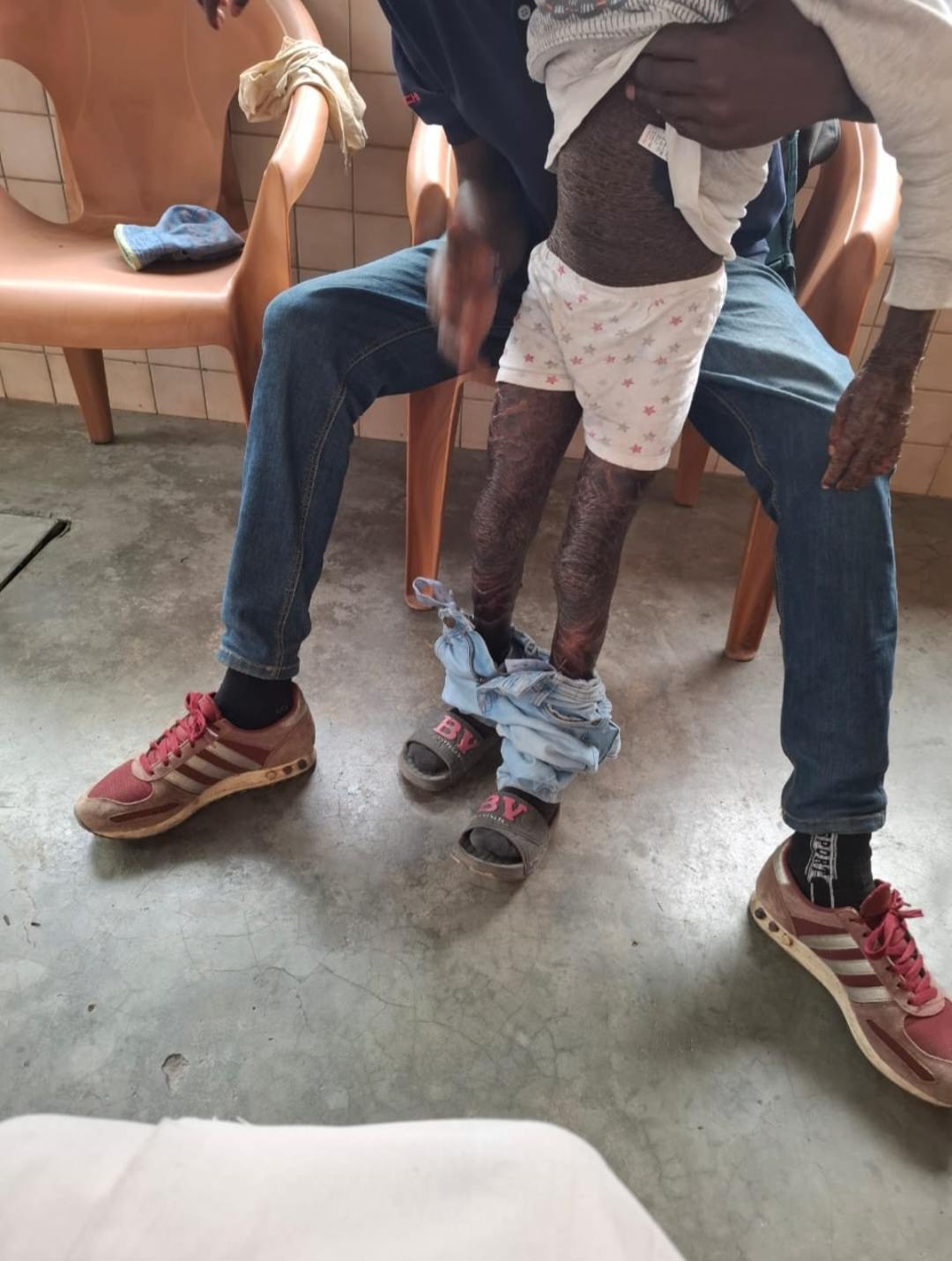 the legs of a boy with a skin affliction