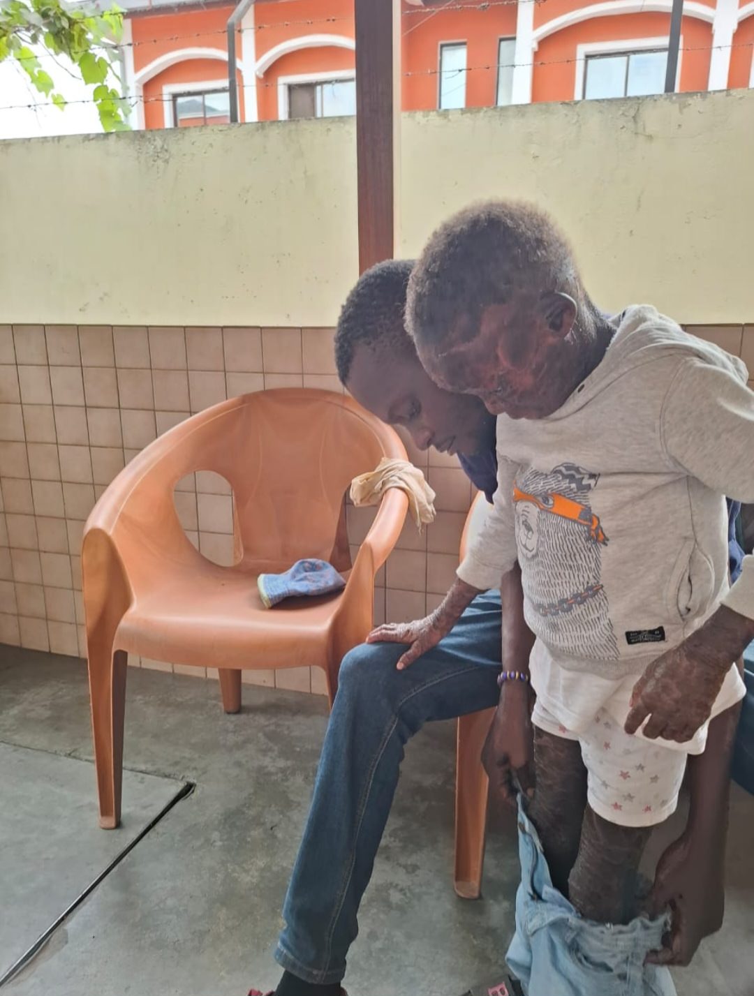 a boy with a skin affliction getting help putting his shorts on