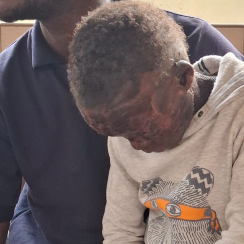thumbnail of zoomed in view of a boy's head showing a skin affliction